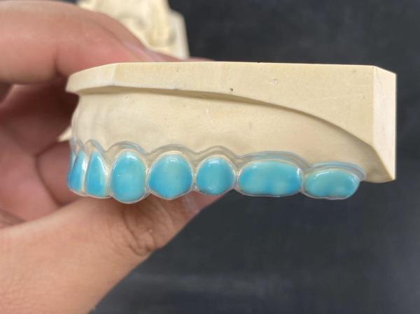 Easy Cleaning Customized Bleach Mouth Guard Food Grade And Anti Coloring