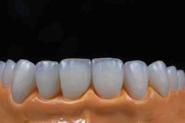 Highly Translucent Esthetic Zirconia Crowns Precise Fit with Natural Looking