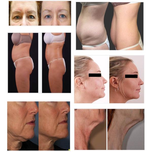 Weight Loss Machine For Body And Face Slimming Laser Beauty Equipment
