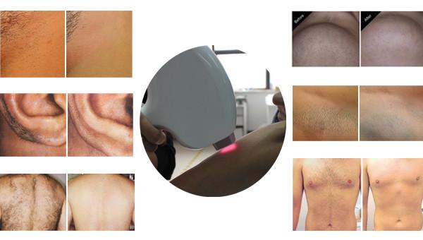800 nm - 810 nm Medical Chin Diode Laser Hair Removal Machine For Clinic / Hospital