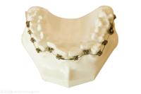 Supports dentaires Orthodontie Outils de modélisation de dents fixes Appareils dentaires