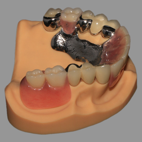 CoCr Acrylic Cast Metal Partial Combined With Fixed PFM