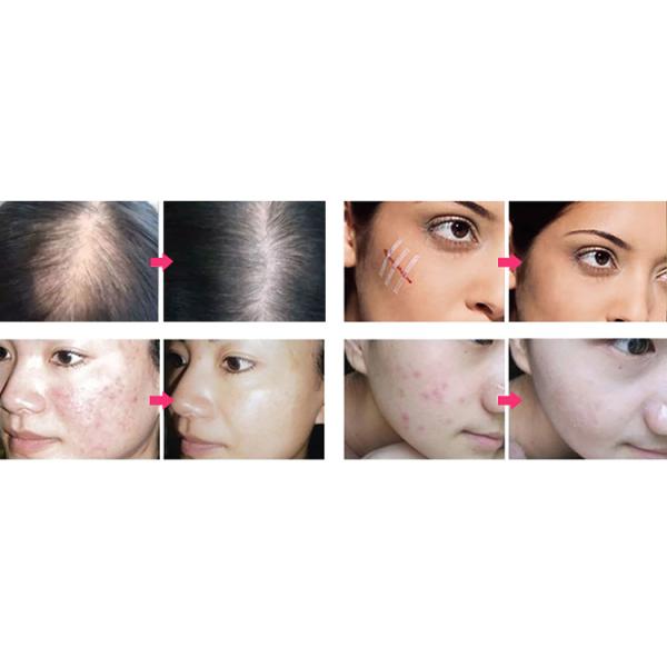 Portable Electrode Tube High Frequency Skin Rejuvenation Beauty Machine