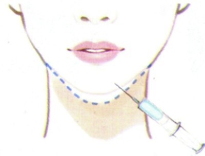 Женский заполнитель Хялуроник кислоты заботы лицевой для увеличения Чин продолжительного