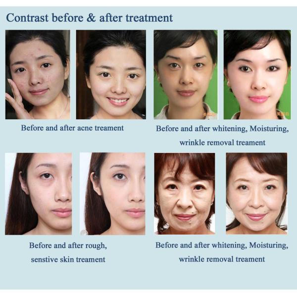 Skin Beauty Water Mesotherapy Equipment Vacuum Injection HIFU