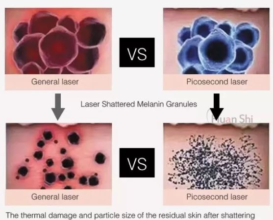 Лазер удаления 1064nm 532nm 755nm Pico пигмента удаления татуировки пикосекунды Машина лазера пикосекунды лазера yag nd машины удаления татуировки удаления 1064nm 532nm пигмента удаления татуировки пикосекунды