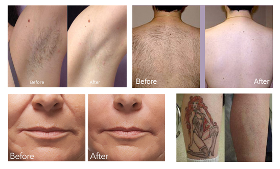 Three Handles RF Q Swithch Laser Beauty Equipment Pigmented Lesions Removal