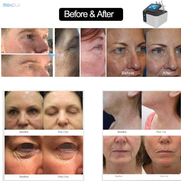 Máquina de beleza de plasma fracionado de CO2 para remoção e esterilização de acne