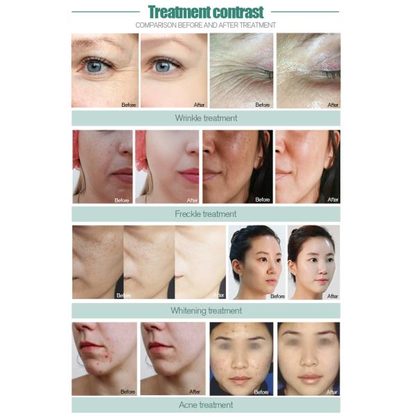 3 in 1 Oxygen Skin Tighten Wrinkle Removal Skin Whitening Jet Peel Oxygen Therapy Facial Machine