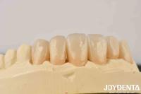 Deja que la luz baile en el edificio de zirconia la transparencia del esmalte y el calor de Dentin