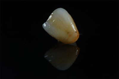 China-Based Dental Lab: Natural Shade Zirconia Crown - High Strength Restoration