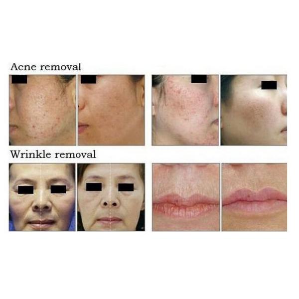 Powerful And Professional Co2 Fractional Laser Scar Removal Machine Rf Metal Tube