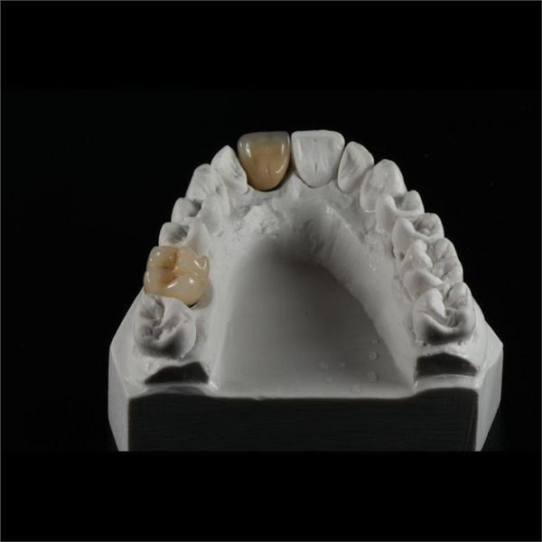 Dentists Cad Cam PFM Crown Ceramic Material Metal Foundation