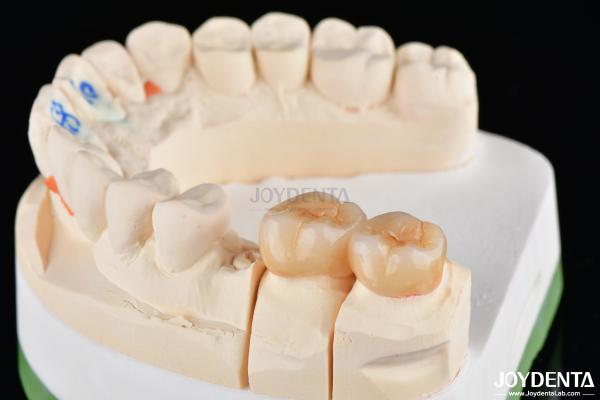 Natural Looking Dental Zirconia Inlays And Onlays High Esthetically Precise Fit