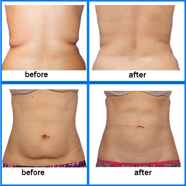 Dispositivo frio 1Hz do laser do diodo 650nm portátil - 1000Hz para a remoção das celulites