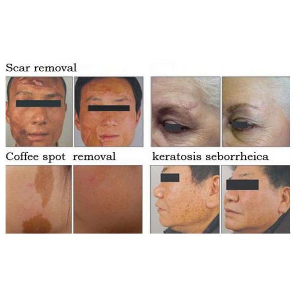 professional fractional co2 laser / skin resurfacing laser / scar removal machine