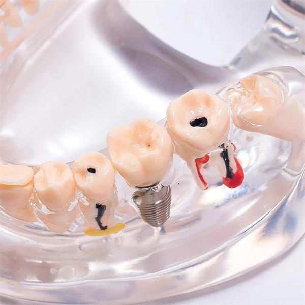 32 Tooth Full Month Implant Disease Teeth Model Clear Design  Dental Pathology Model