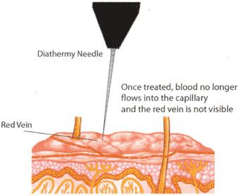 Effective 30Mhz high frequency spider vein removal Facial Vein Clearance Machine
