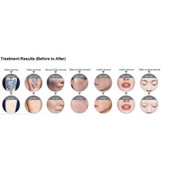 Tattoo Removal Equipment Vertical ND YAG Skin Tightening Laser Machine