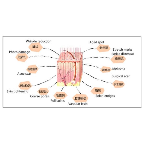 40W 10600nm RF Metal Tube Fractional Co2 Laser Machine with Vaginal Treatment