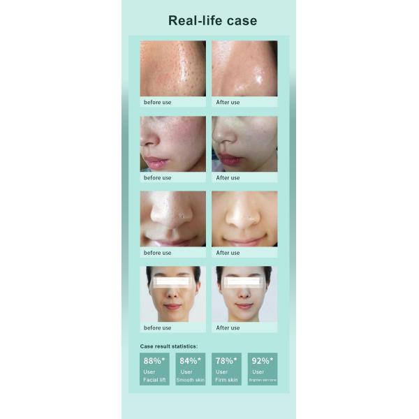 Двигатель Aqua воды слезает красоту профессионального ухода за лицом машины Microdermabrasion поднимаясь