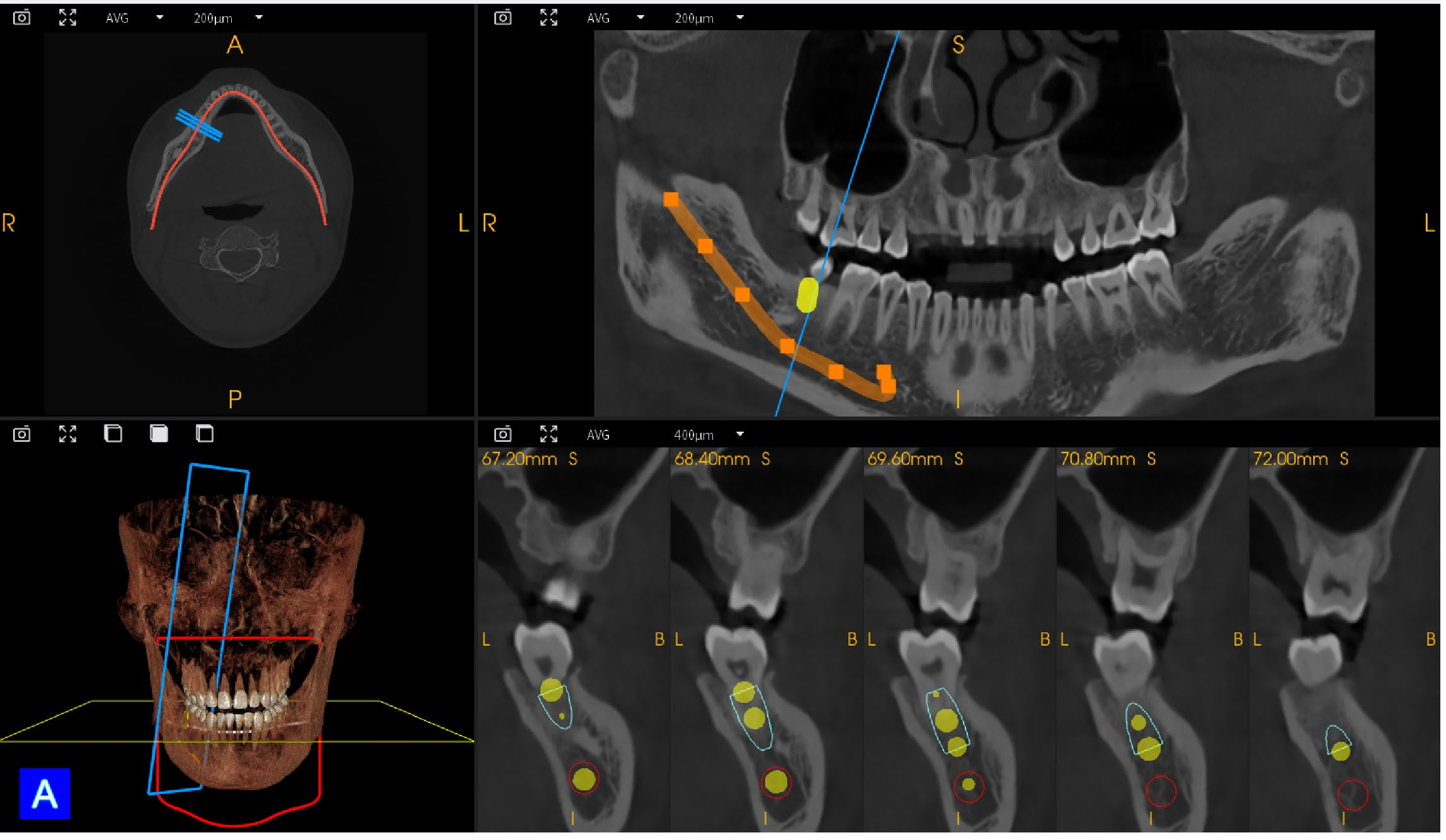 Dental Implant Orthodontic CBCT System High-Resolution 3D Imaging for Precise Diagnosis