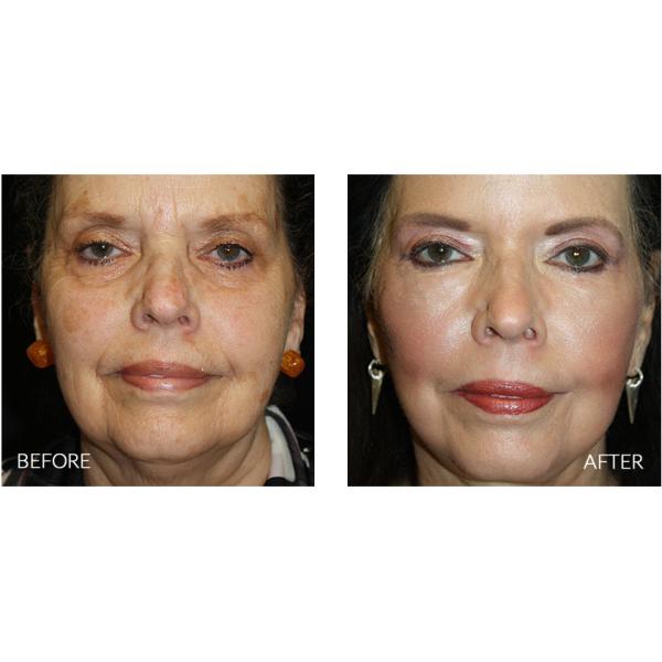 La regeneración de la piel de Hyamely estimula el líquido transparente del suero del colágeno PDRN