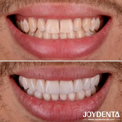 Parfaitement adapté Porcelaine Veneers dentaires Transparence naturelle Veneers dentaires stratifiés