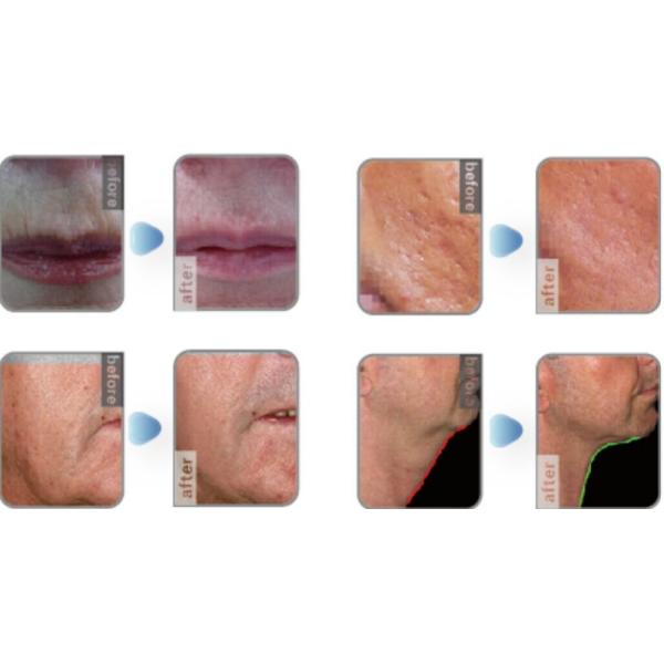 laser hair removal diode laser hair removal machine price