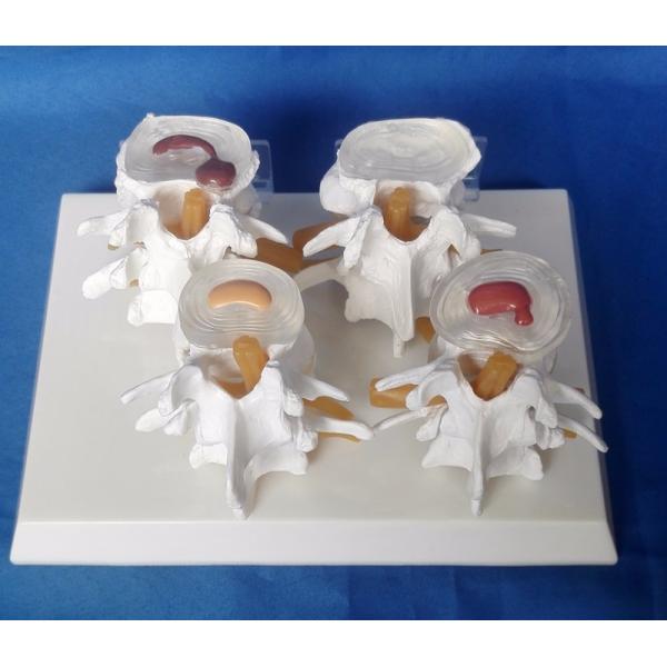 Vertebrae Diseased 4 Stage PVC Human Lumbar Spine Anatomy Model