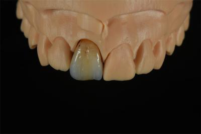 Affordable Zirconia Crowns with Custom Color Staining - China Dental Lab