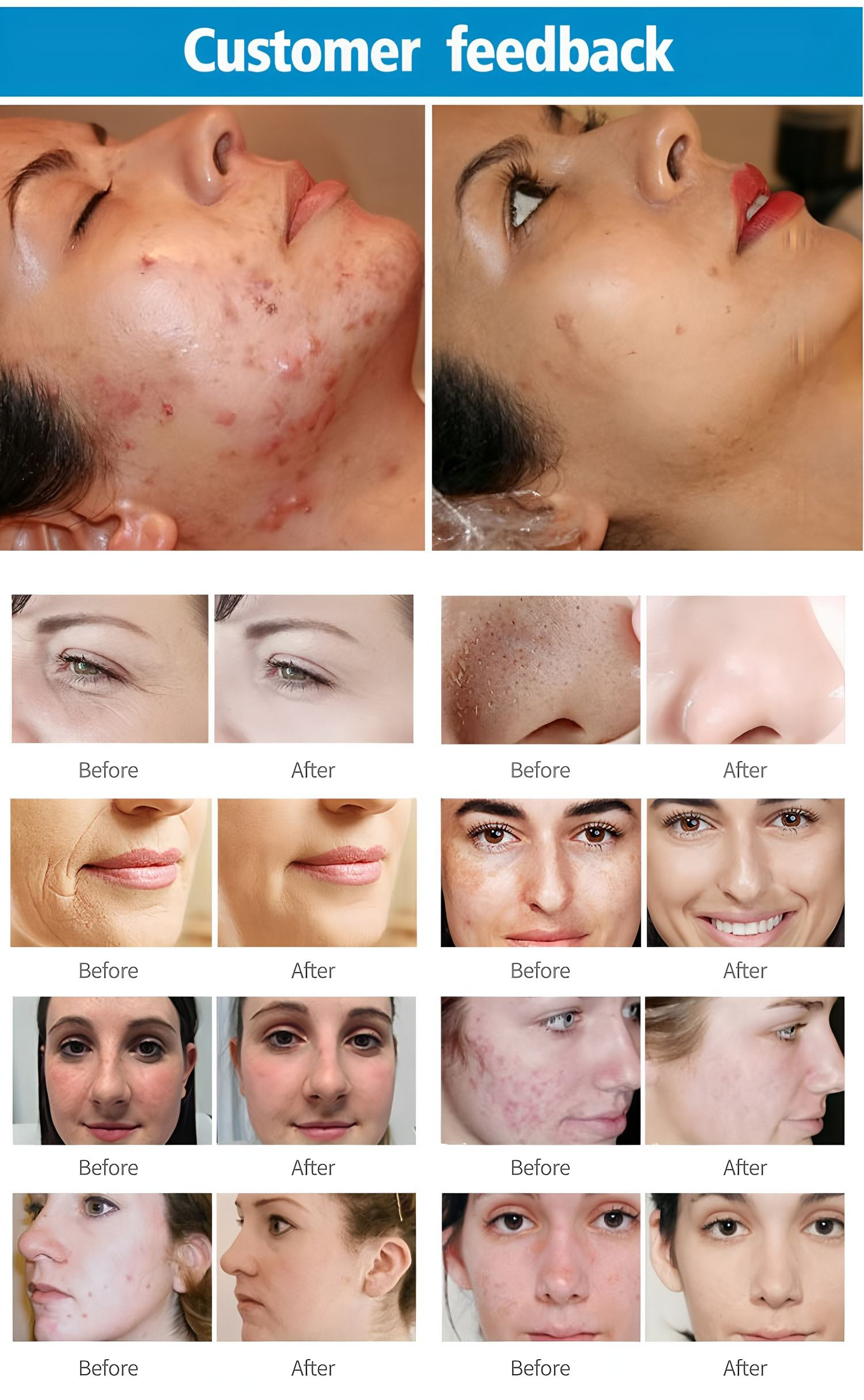 4D Fractional CO2 Laser Machine 60W for Skin Resurfacing / Scar Removal