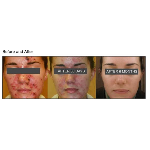 Beauty Salon Pdt Led Photon Machine Infrared Red Light Therapy Acne Removal Hair Growth