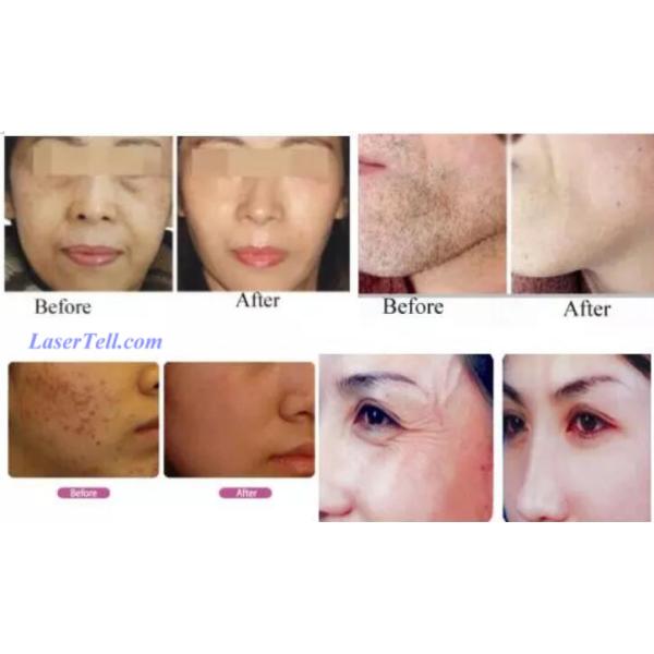 Новое волокно 808нм соединило машину удаления волос лазера диода/лазера диода