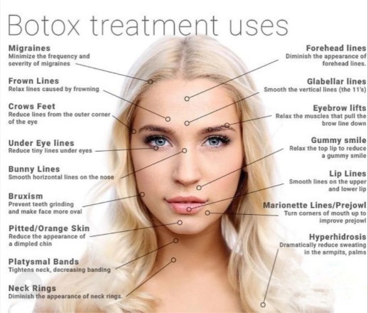 Удаление Allergan  морщинки 100 блоков для возраста впрыски подтяжки лица анти-