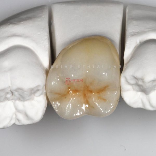 Medical Grade Dental Zirconia Restoration Precision CNC Milling Customized
