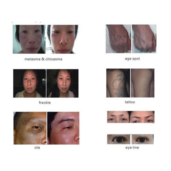 Y11 1064nm / 532nm Tattoo Removal machine For Eyebrow / Embroider Lip