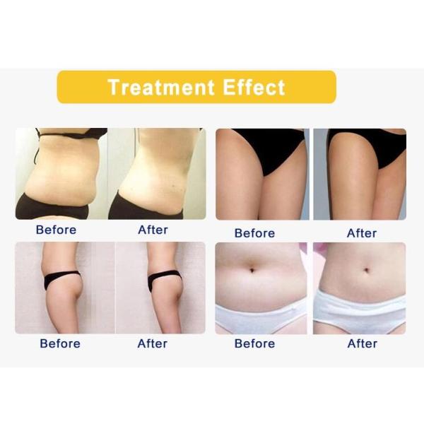 4 Handles Cryolipolysis Fat Freezing Machine With Silica Gel Head CE Certificated