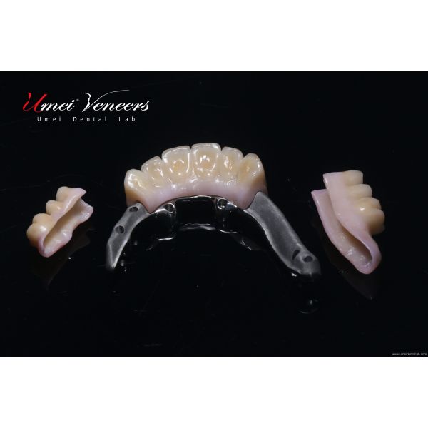 Biocompatible Titanium Marlow Bridge