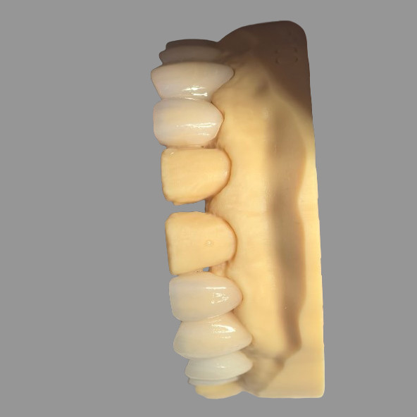 Smooth Pressed IPS EMax Crowns Staining Resistant Customizable