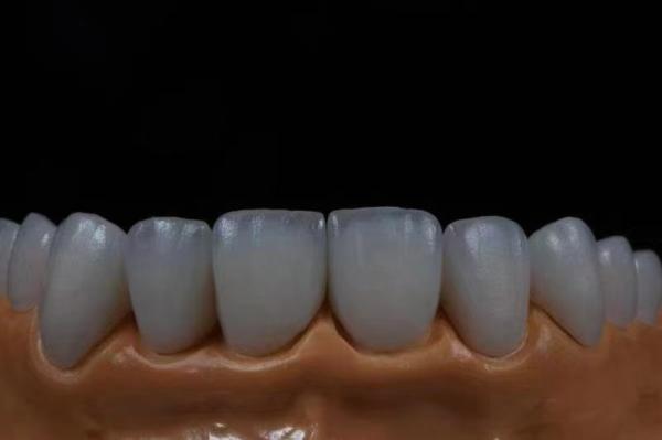 Highly Translucent Esthetic Zirconia Crowns Precise Fit with Natural Looking