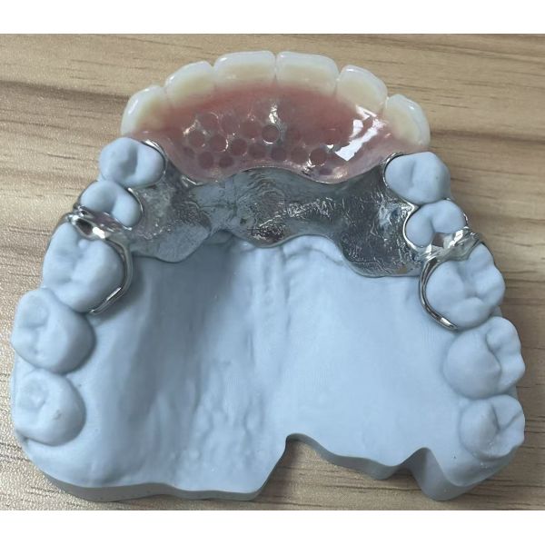 Metal Framework with acrylic partial denture finish