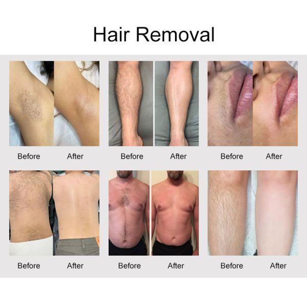 Compact Alexandrite Laser Device Featuring Advanced Cooling and Variable Frequency for Comfortable Patient Experience