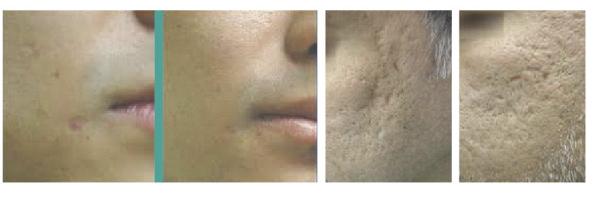 USA Coherent Metal Tube Co2 Fractional Laser Machine for Scar Removal