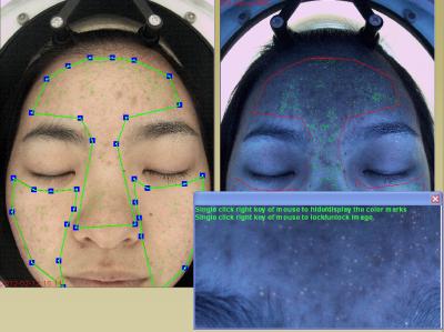 Camada portátil médica da derma do terapeuta do analisador da pele 10 anos de experiência