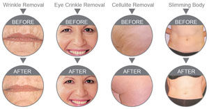 Single Electro Optical Head 2000W 10*12mm RF Beauty Equipment