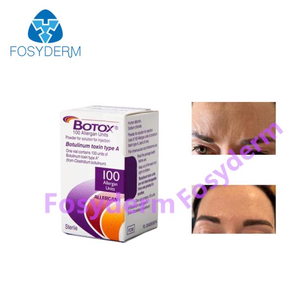 100Units Allergan Botulinum Toxion для извлекают лицевой тип a Botox морщинок