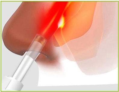 LLLT Red Light Nasal Laser Therapy Device 5 Levels Allergic Rhinitis Treatment Device