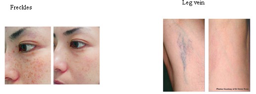 Multifunctional Skin Rejuvenation Beauty Equipment with Spot Size 15 * 35 mm²