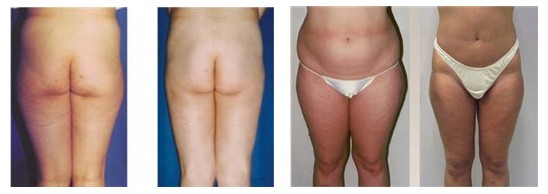 Vertical Machine Ultrasound System Device Skin Spot Treatment Slimming Equipment Weight 51kgs